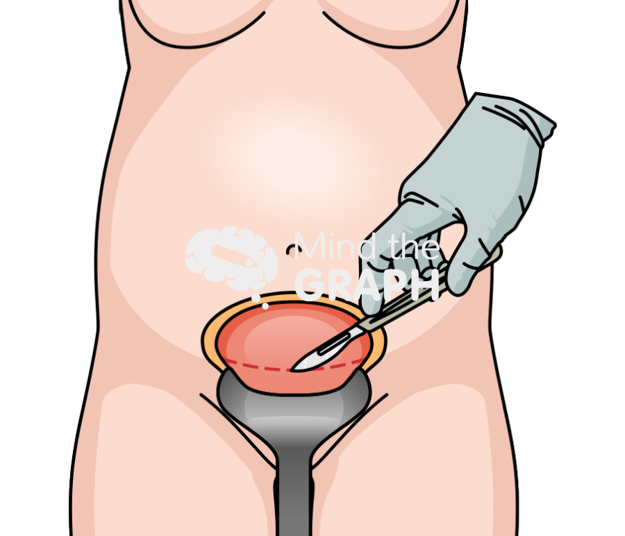 Cesarean section surgery incision front Icons, Symbols, Pictures, and Images