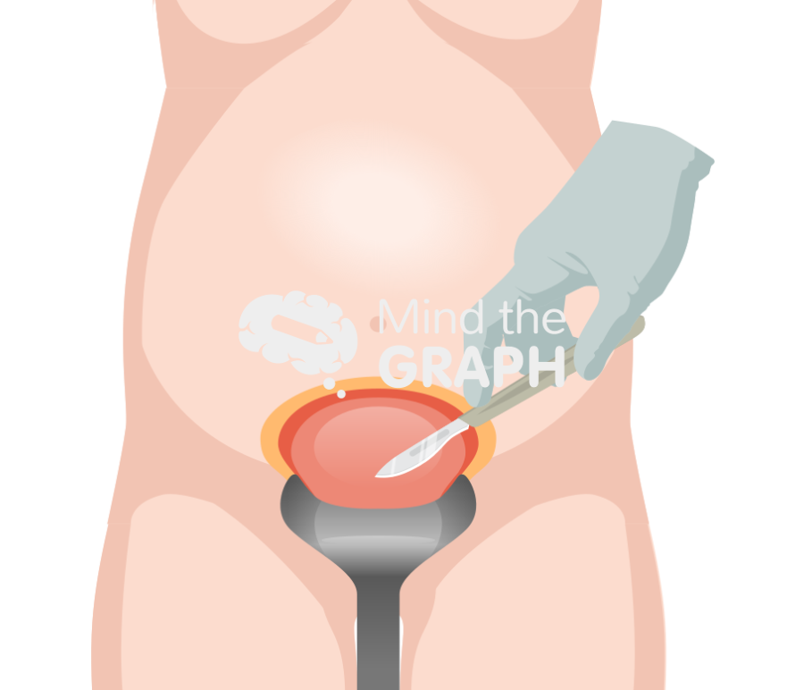Cesarean section surgery incision front Icons, Symbols, Pictures, and Images