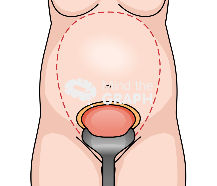 Cesarean section surgery uterus front Icons, Symbols, Pictures, and Images