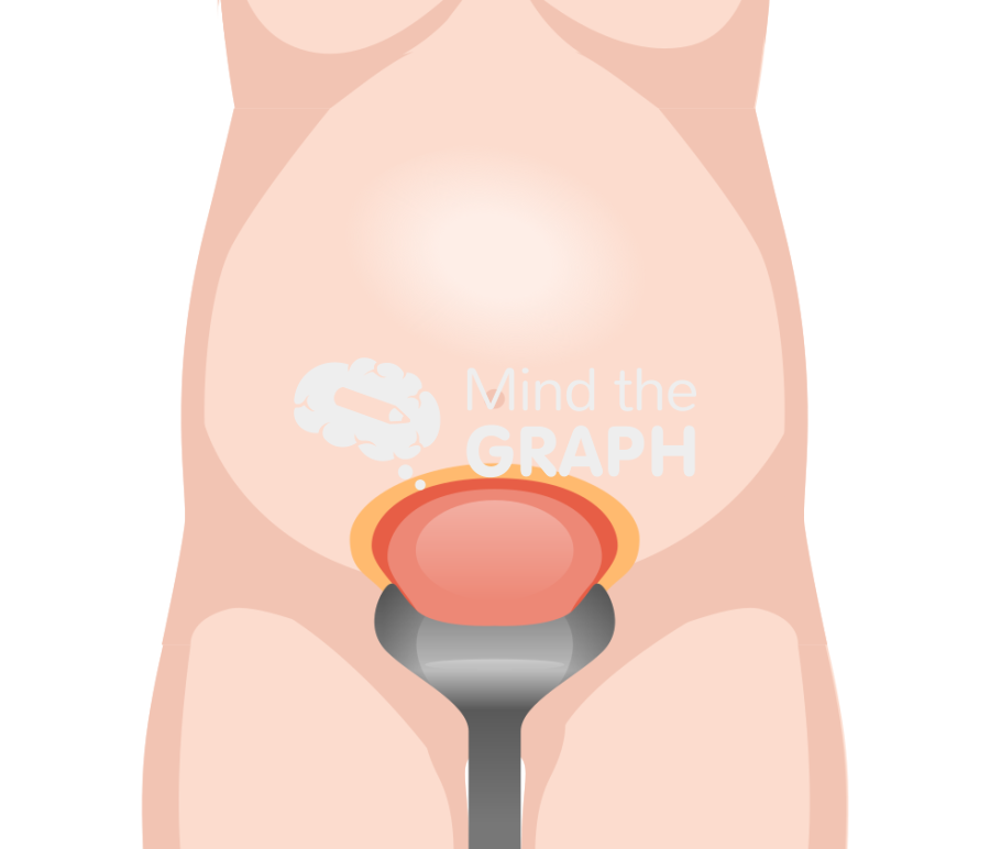 Cesarean section surgery uterus front Icons, Symbols, Pictures, and Images