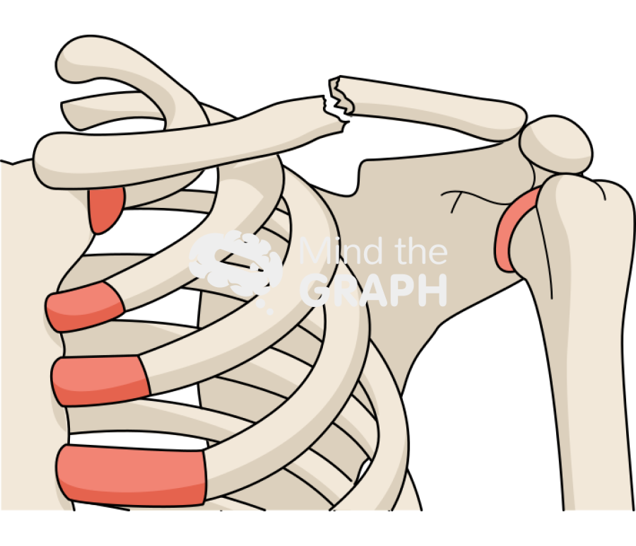 Clavicle fracture Icons, Symbols, Pictures, and Images