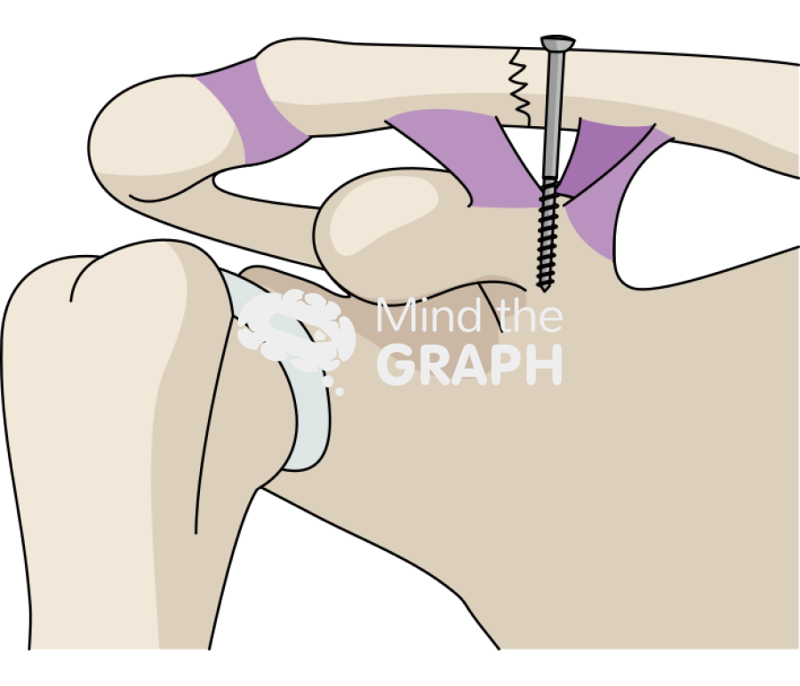 Clavicle fracture bosworth screw technique Icons, Symbols, Pictures, and Images