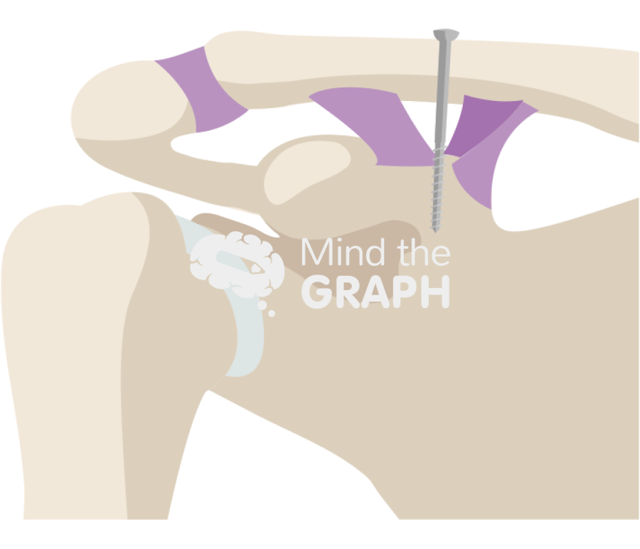 Clavicle fracture bosworth screw technique Icons, Symbols, Pictures, and Images