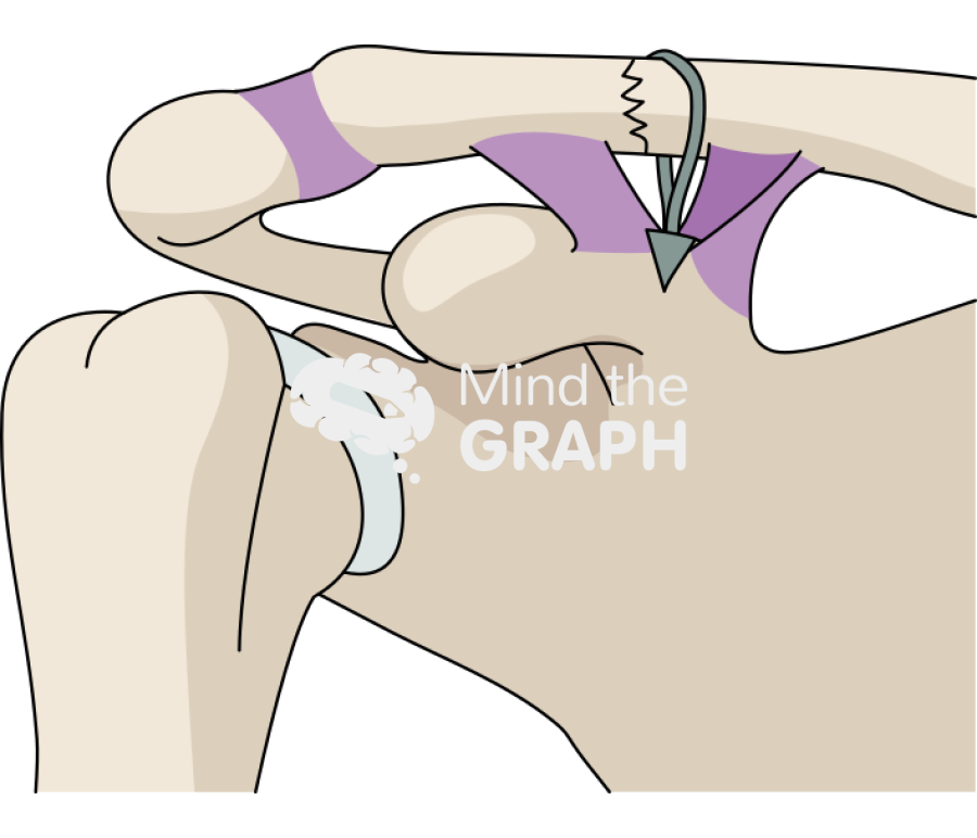 Clavicle fracture cc sling technique 1 Icons, Symbols, Pictures, and Images