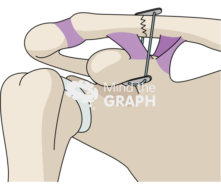Clavicle fracture cc sling technique 2 Icons, Symbols, Pictures, and Images