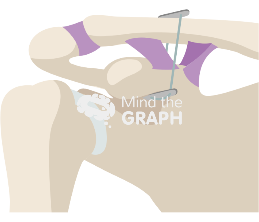 Clavicle fracture cc sling technique 2 Icons, Symbols, Pictures, and Images