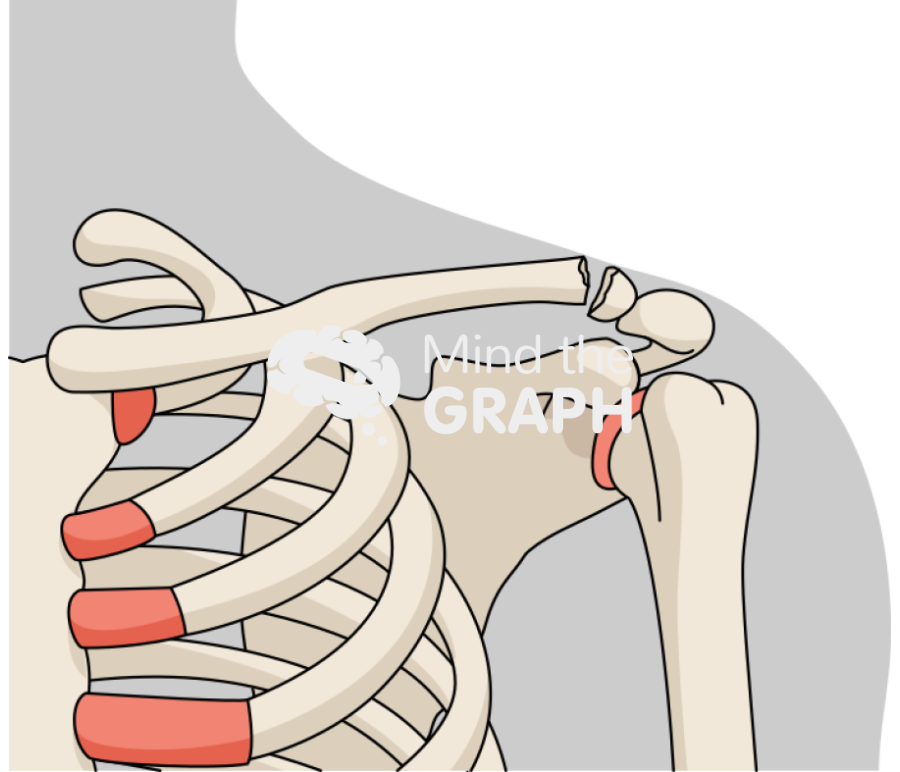 Clavicle fracture distal body Icons, Symbols, Pictures, and Images