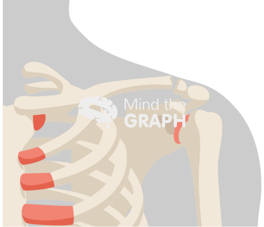 Clavicle fracture distal body Icons, Symbols, Pictures, and Images
