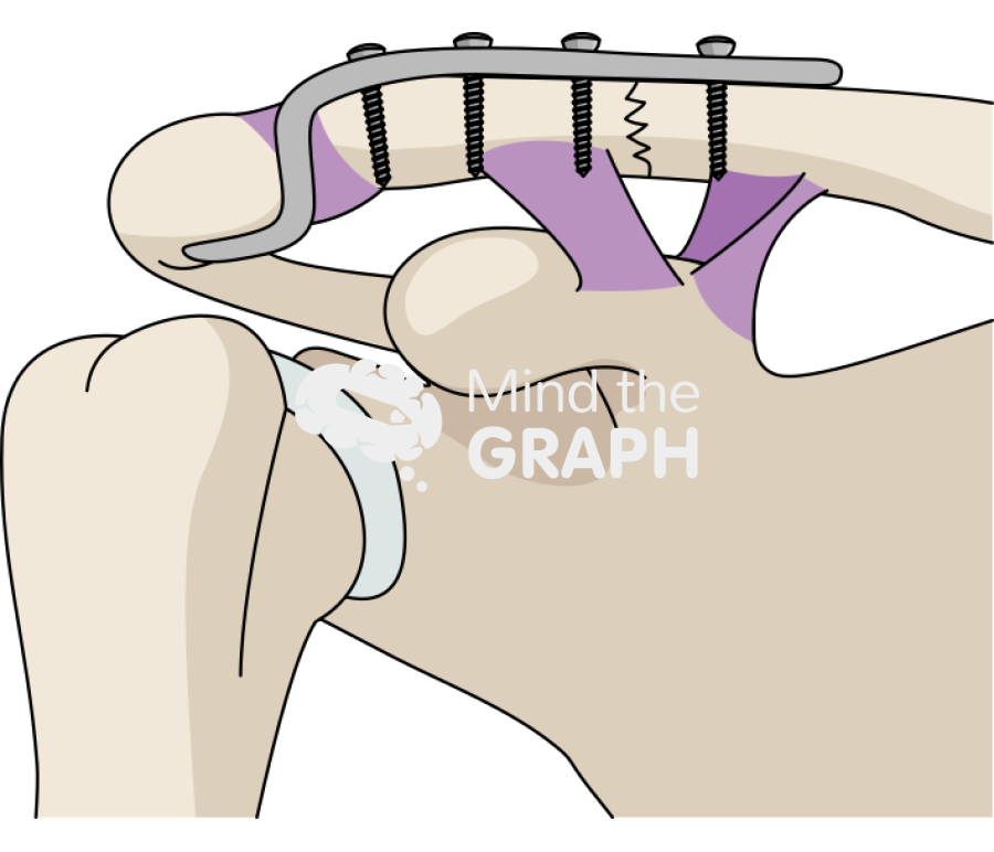 Clavicle fracture hook plate Icons, Symbols, Pictures, and Images