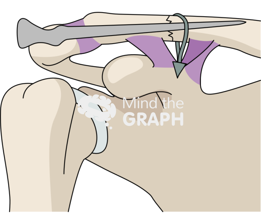 Clavicle fracture knowless pin cc sling Icons, Symbols, Pictures, and Images