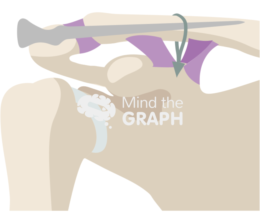 Clavicle fracture knowless pin cc sling Icons, Symbols, Pictures, and Images