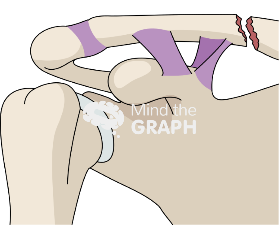 Clavicle fracture neer type iia Icons, Symbols, Pictures, and Images