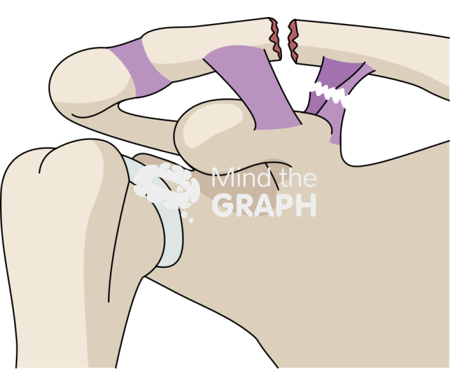 Clavicle fracture neer type iib Icons, Symbols, Pictures, and Images