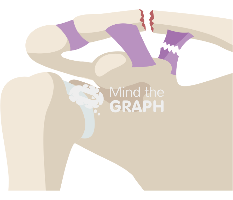Clavicle fracture neer type iib Icons, Symbols, Pictures, and Images