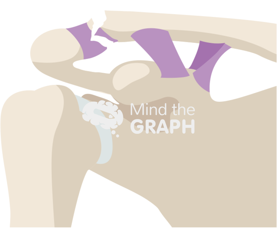 Clavicle fracture neer type iii Icons, Symbols, Pictures, and Images