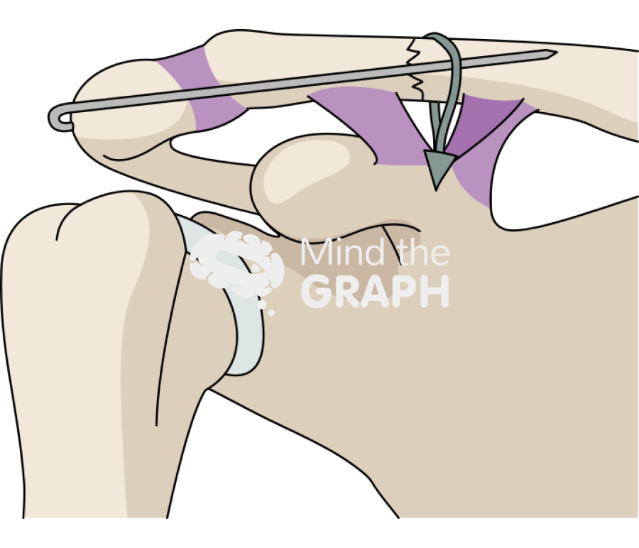 Clavicle fracture single k wire cc sling Icons, Symbols, Pictures, and Images