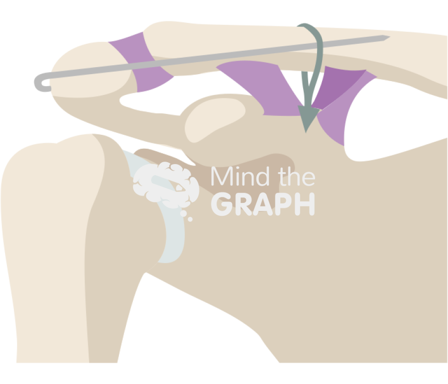 Clavicle fracture single k wire cc sling Icons, Symbols, Pictures, and Images