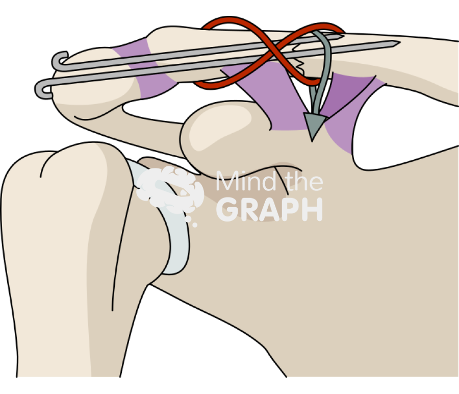 Clavicle fracture tbw parallel k wire cc sling Icons, Symbols, Pictures, and Images