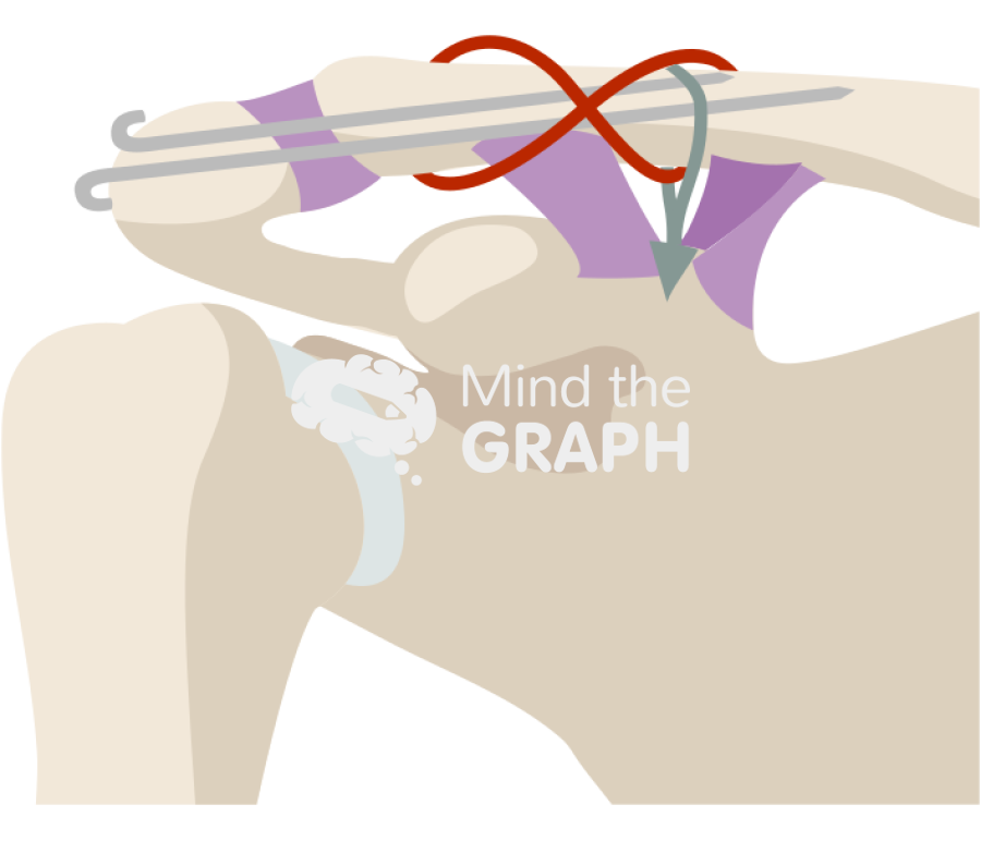 Clavicle fracture tbw parallel k wire cc sling Icons, Symbols, Pictures, and Images