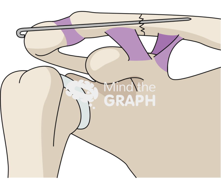 Clavicle fracture transacromial single k wire Icons, Symbols, Pictures, and Images