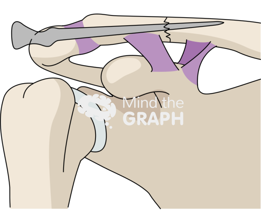 Clavicle fracture transacromial single knowlesspin Icons, Symbols, Pictures, and Images