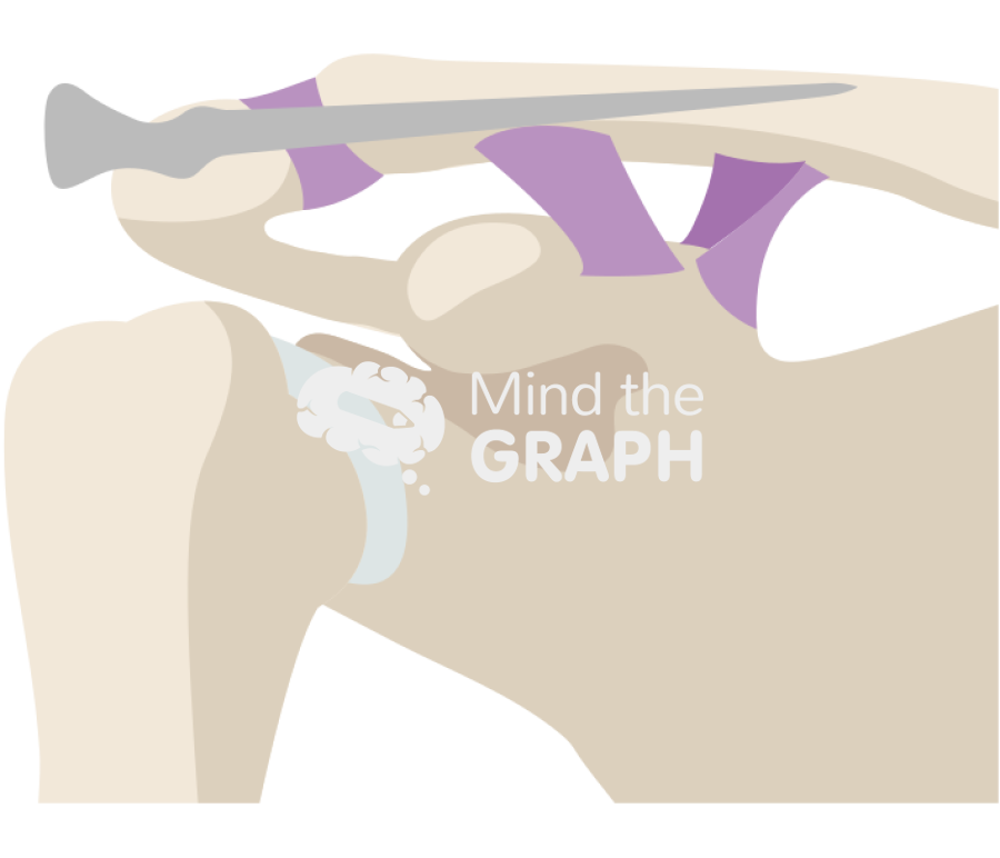 Clavicle fracture transacromial single knowlesspin Icons, Symbols, Pictures, and Images