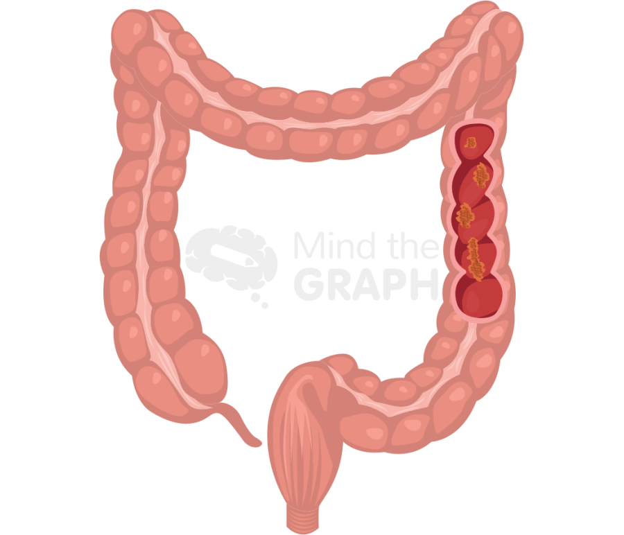 Colorectal cancer Icons, Symbols, Pictures, and Images