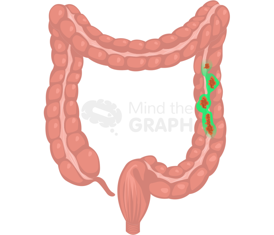 Colorectal cancer indocyanine green icg Icons, Symbols, Pictures, and Images