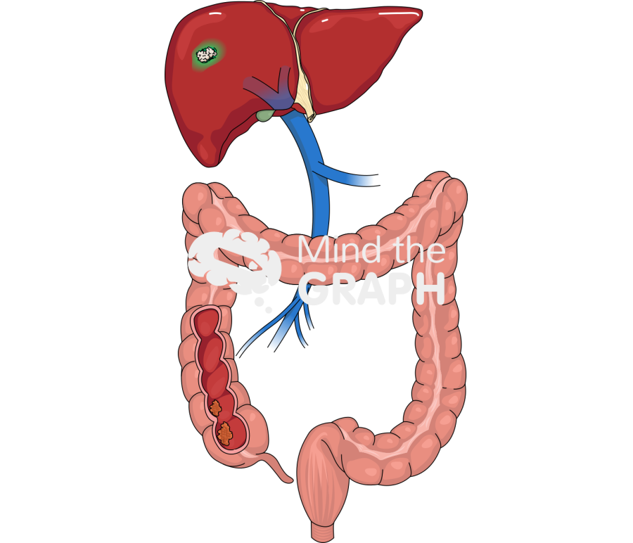 Colorectal liver metastasis indocyanine green icg Icons, Symbols, Pictures, and Images