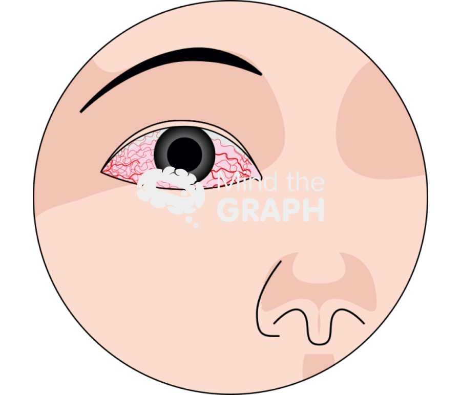 Conjunctivitis Icons, Symbols, Pictures, and Images