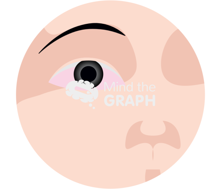 Conjunctivitis Icons, Symbols, Pictures, and Images