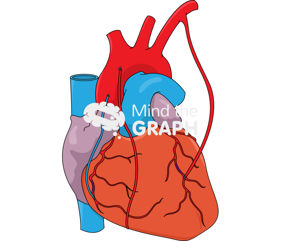 Coronary artery bypass grafting 2 Icons, Symbols, Pictures, and Images