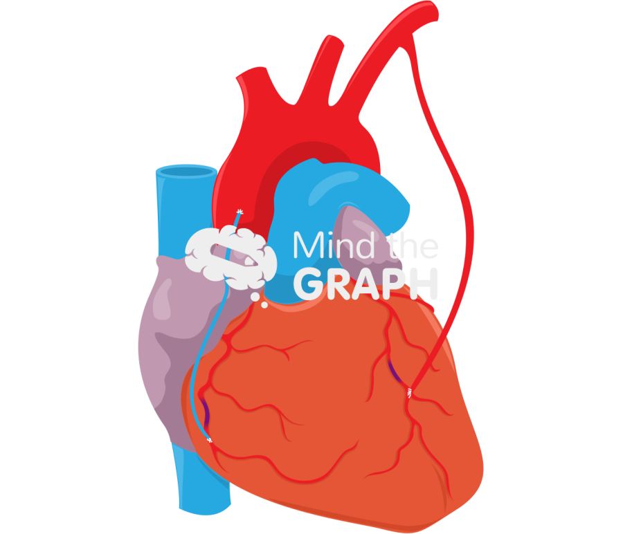Coronary artery bypass grafting 4 Icons, Symbols, Pictures, and Images