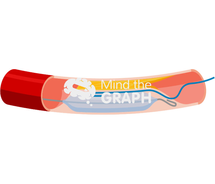 Coronary artery long chronic total occlusion stent 1 longitudinal cut Icons, Symbols, Pictures, and Images