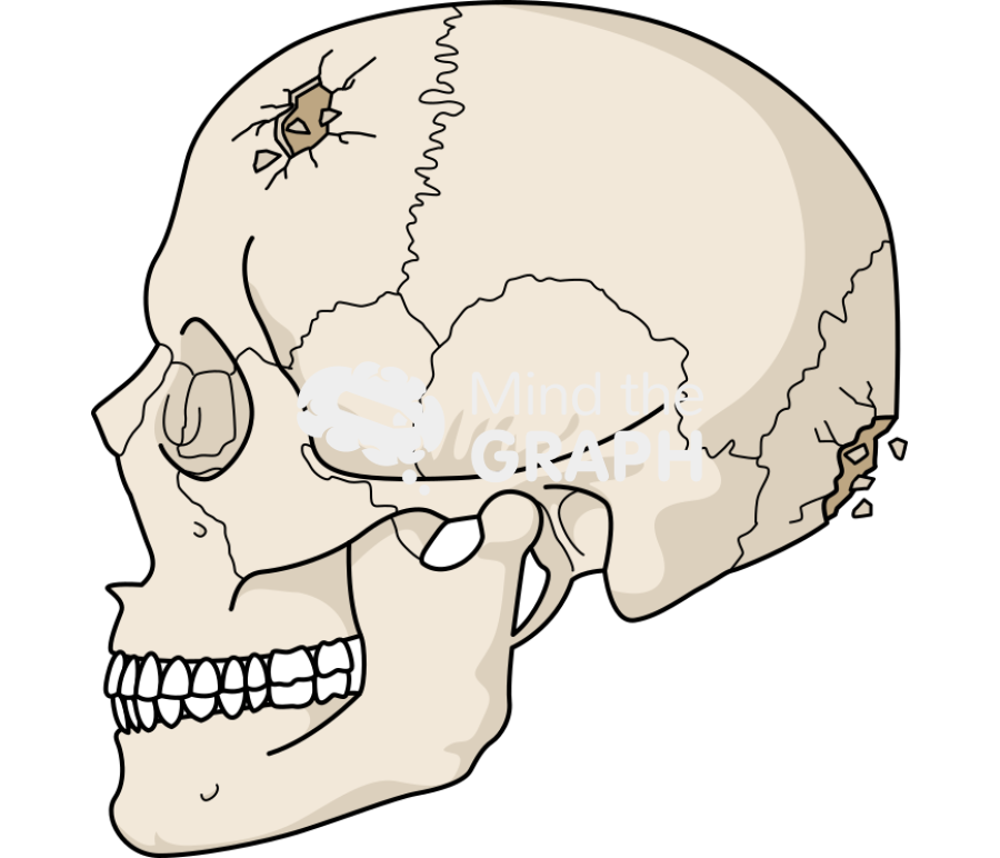 Cranium fracture side Icons, Symbols, Pictures, and Images