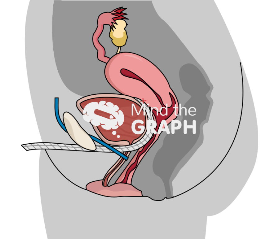 Cystocele correction transobturator sling lateral cut Icons, Symbols, Pictures, and Images