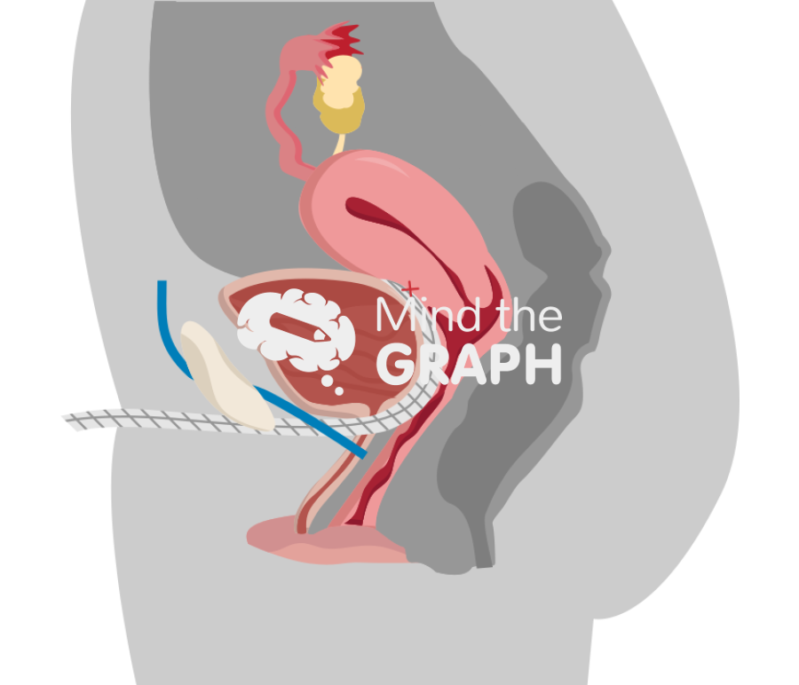 Cystocele correction transobturator sling lateral cut Icons, Symbols, Pictures, and Images