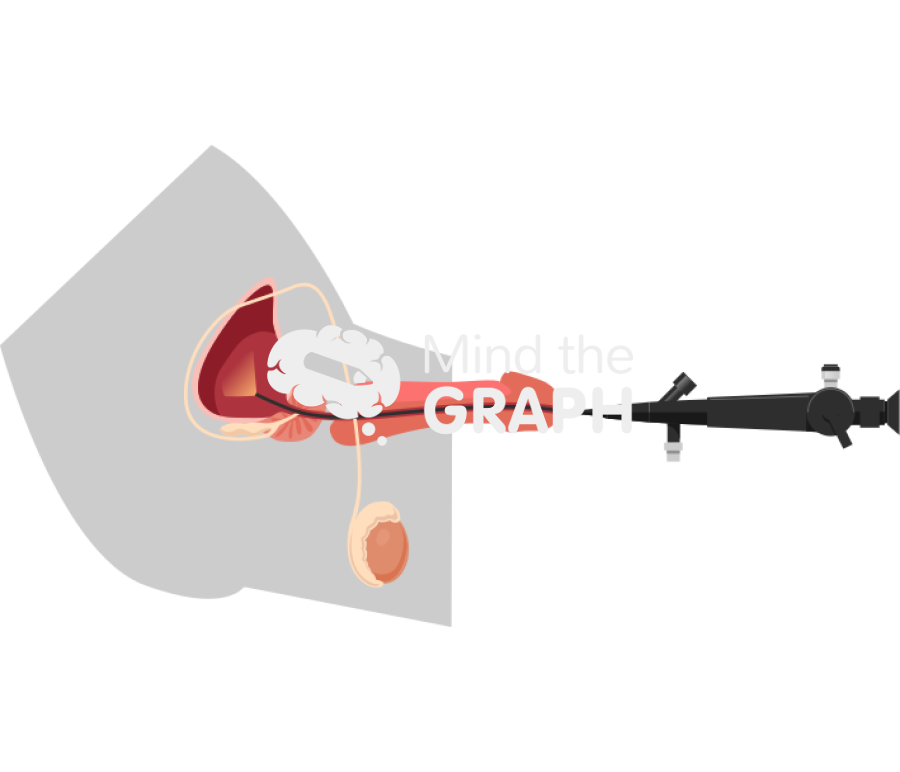 Cystoscopy flexible man procedure body cut Icons, Symbols, Pictures, and Images