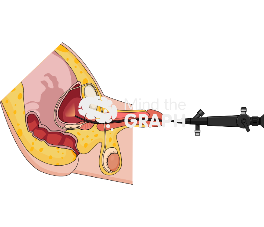 Cystoscopy flexible man procedure cut Icons, Symbols, Pictures, and Images