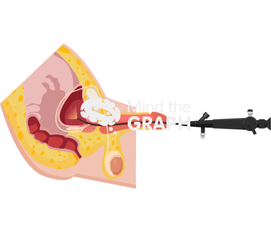 Cystoscopy flexible man procedure cut Icons, Symbols, Pictures, and Images