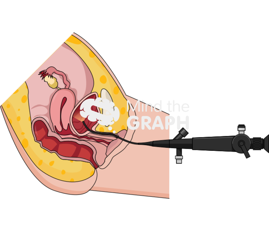 Cystoscopy flexible woman procedure cut Icons, Symbols, Pictures, and Images
