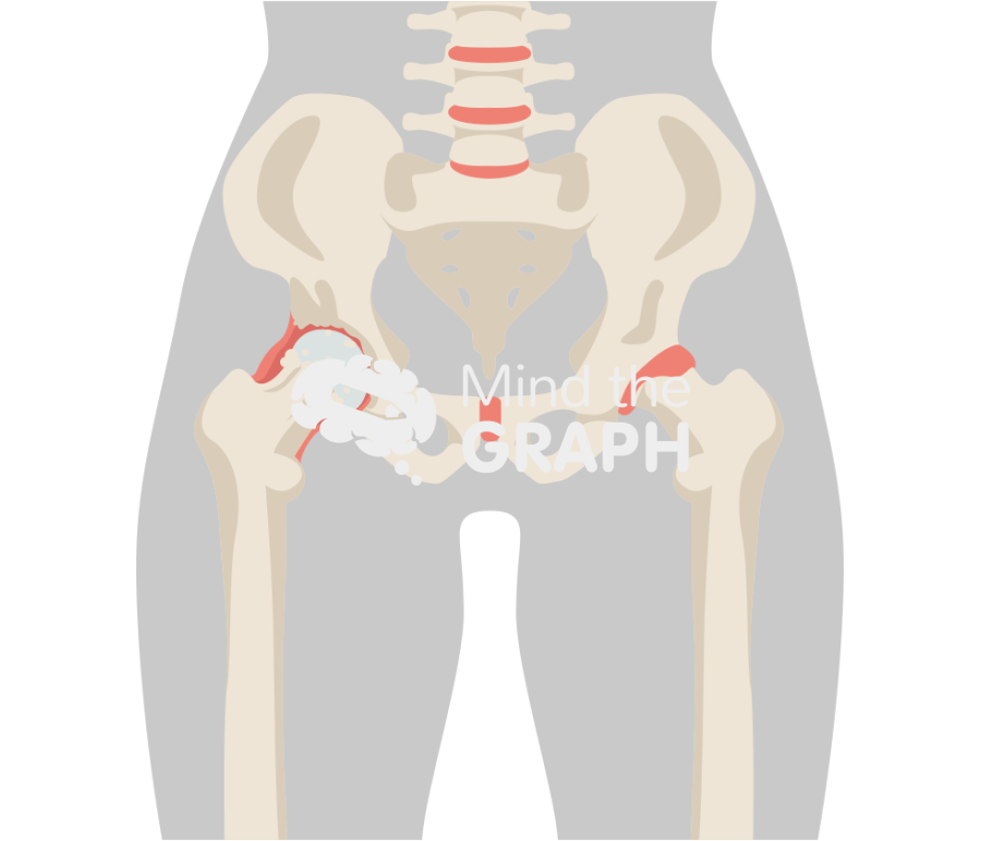 Degenerative joint disease hip animation body Icons, Symbols, Pictures, and Images