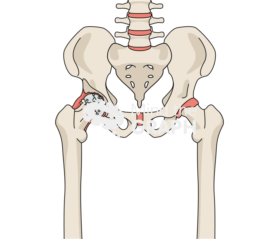 Degenerative joint disease hip animation bone full Icons, Symbols, Pictures, and Images