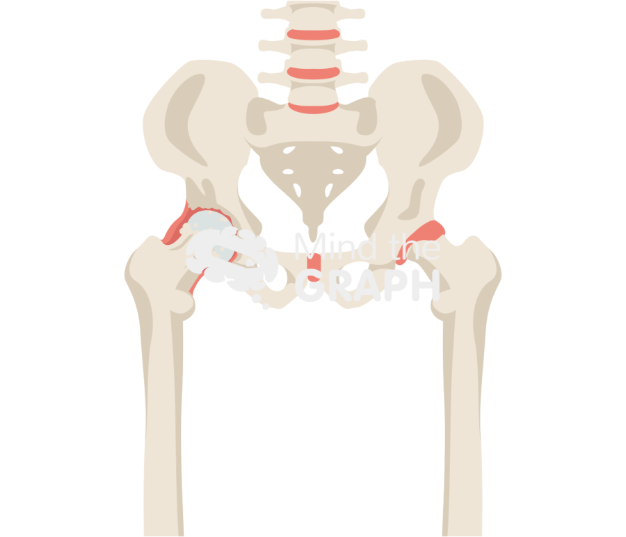 Degenerative joint disease hip animation bone full Icons, Symbols, Pictures, and Images
