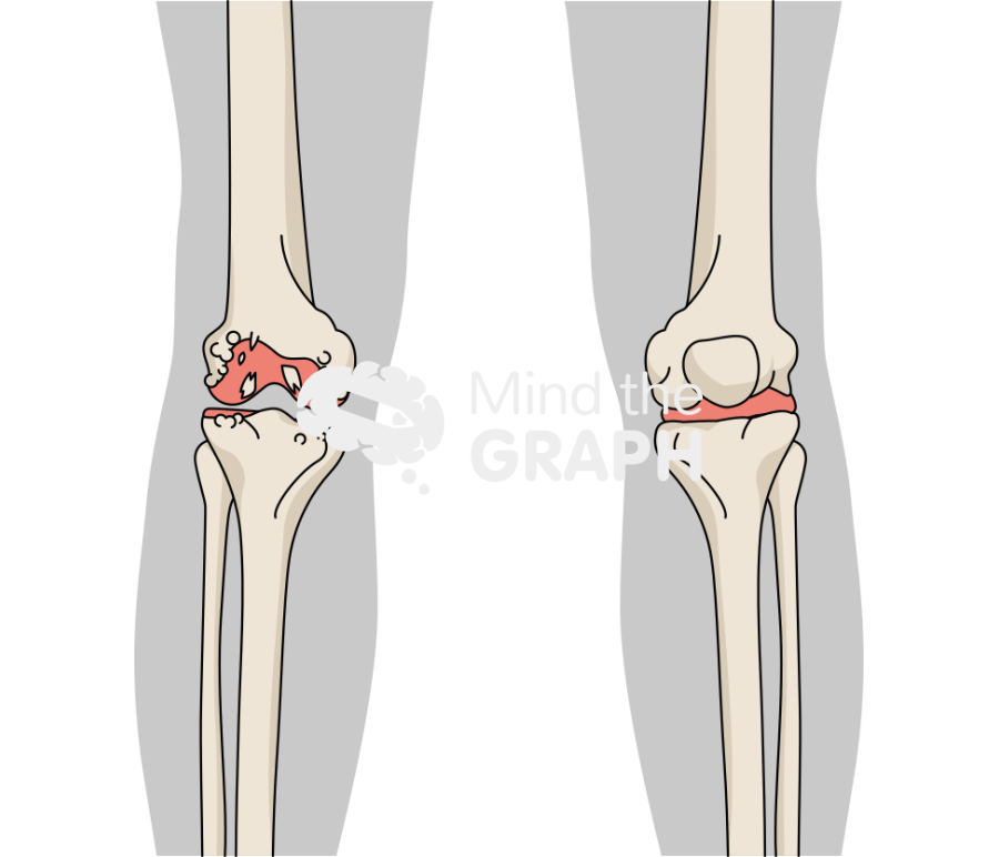 Degenerative joint disease knee animation body Icons, Symbols, Pictures, and Images