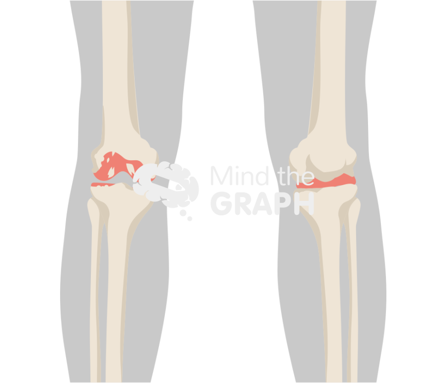 Degenerative joint disease knee animation body Icons, Symbols, Pictures, and Images