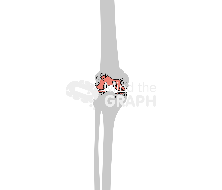 Degenerative joint disease knee animation bone Icons, Symbols, Pictures, and Images