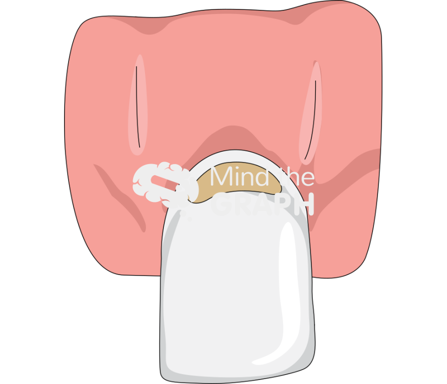 Dental abrasion front view Icons, Symbols, Pictures, and Images