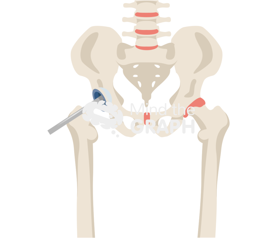 Direct anterior cup placement bone full Icons, Symbols, Pictures, and Images