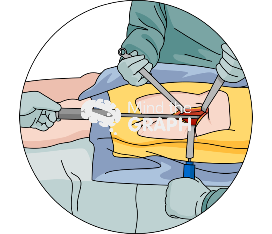 Direct anterior cup placement zoom Icons, Symbols, Pictures, and Images